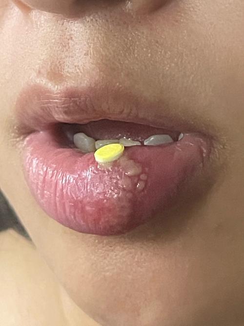 口腔溃疡为何会变成洞?