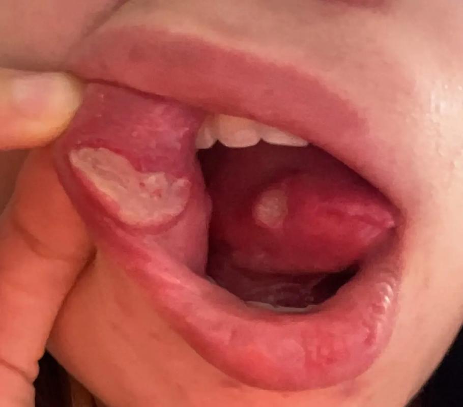 口腔溃疡会持续变大吗?