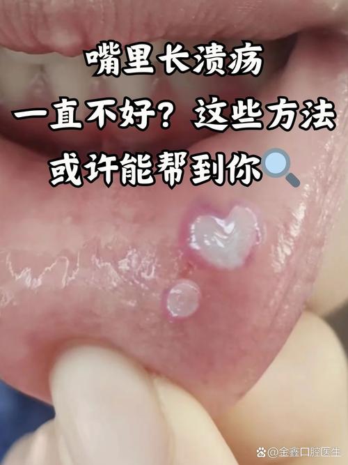 口腔溃疡会持续变大吗?
