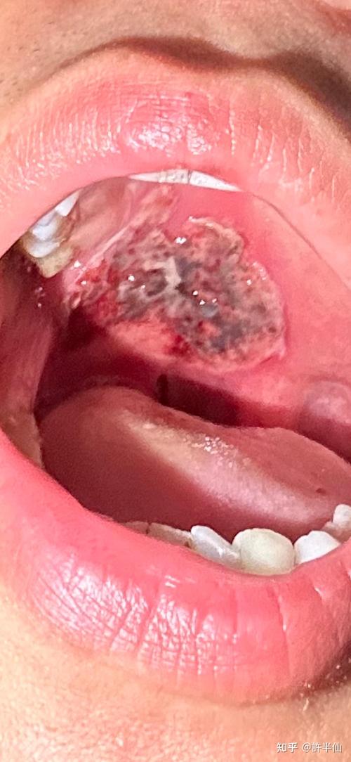 口腔溃疡会持续变大吗?