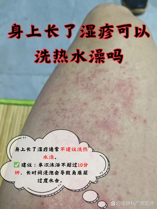 搓澡后皮肤痒,是搓掉了保护层吗?