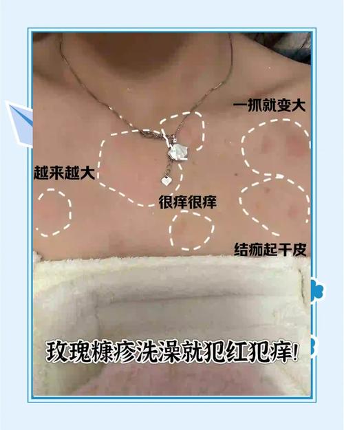 搓澡后皮肤痒,是搓掉了保护层吗?