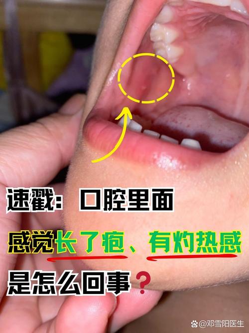 吃太烫的东西口腔起皮怎么办?