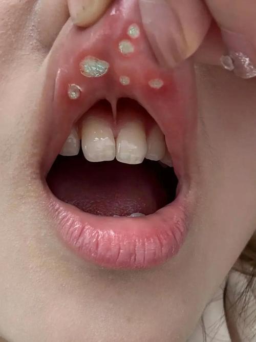 吃太烫的东西口腔起皮怎么办?