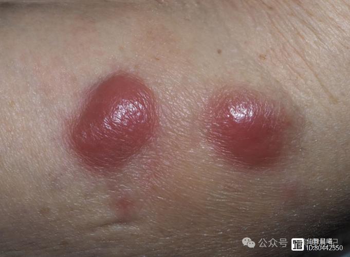 淋巴瘤皮肤表现图片有哪些典型特征?