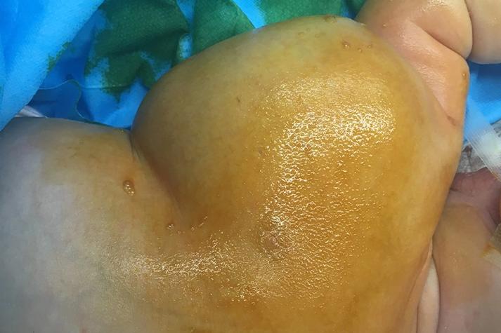 淋巴瘤皮肤表现图片有哪些典型特征?