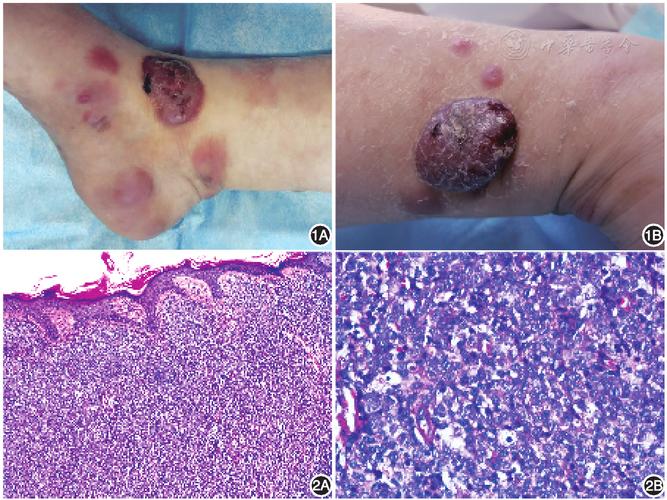 淋巴瘤皮肤表现图片有哪些典型特征?
