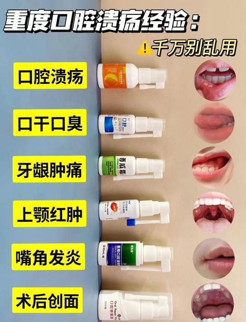 口腔溃疡反复发作怎么办?