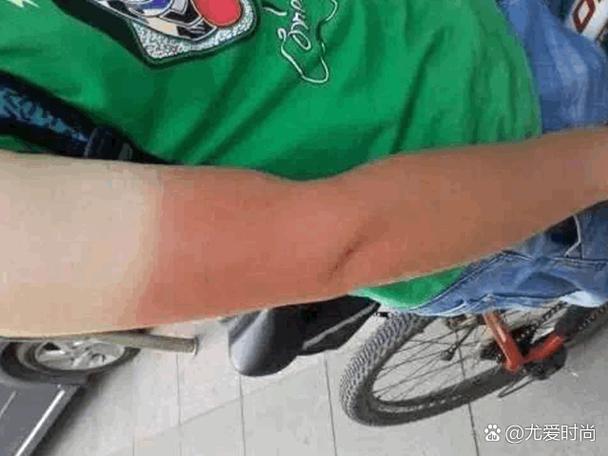 红外线会让皮肤变黑吗?