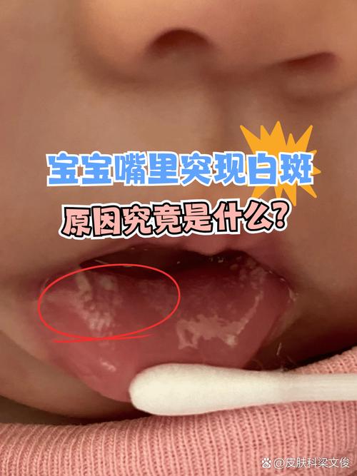 新生儿口腔两侧大片白是鹅口疮还是其他问题?