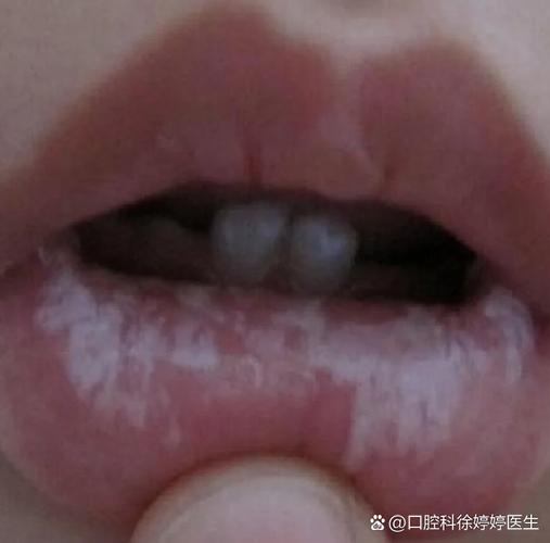 新生儿口腔两侧大片白是鹅口疮还是其他问题?