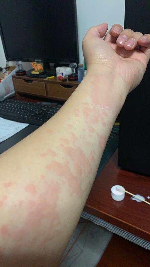 皮肤红痒起疙瘩是过敏还是皮肤病?