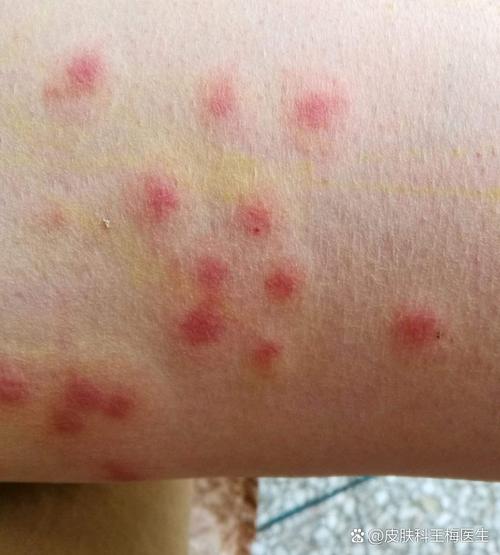 皮肤红痒起疙瘩是过敏还是皮肤病?