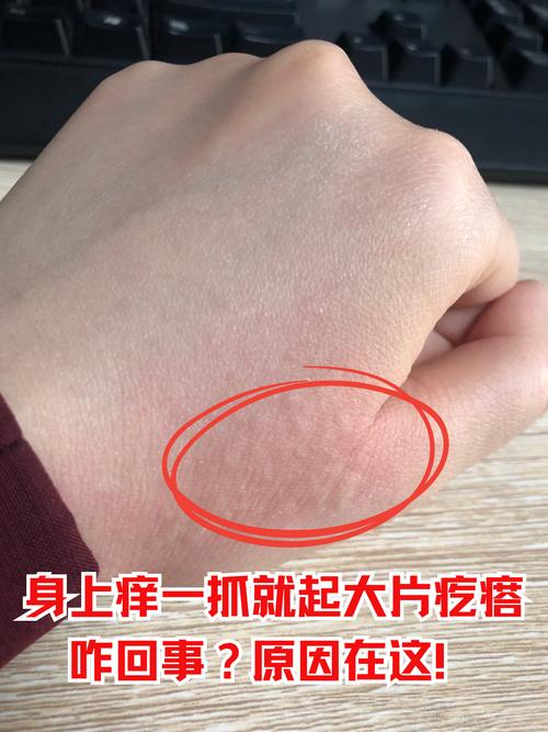 皮肤红痒起疙瘩是过敏还是皮肤病?