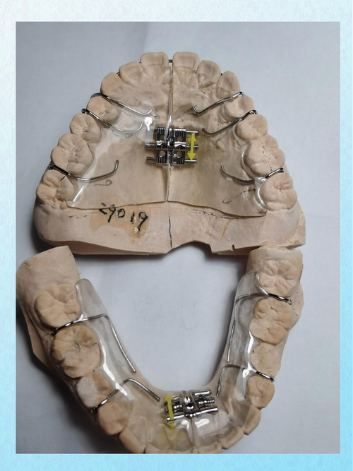 口腔医院下颌骨矫正器效果如何?