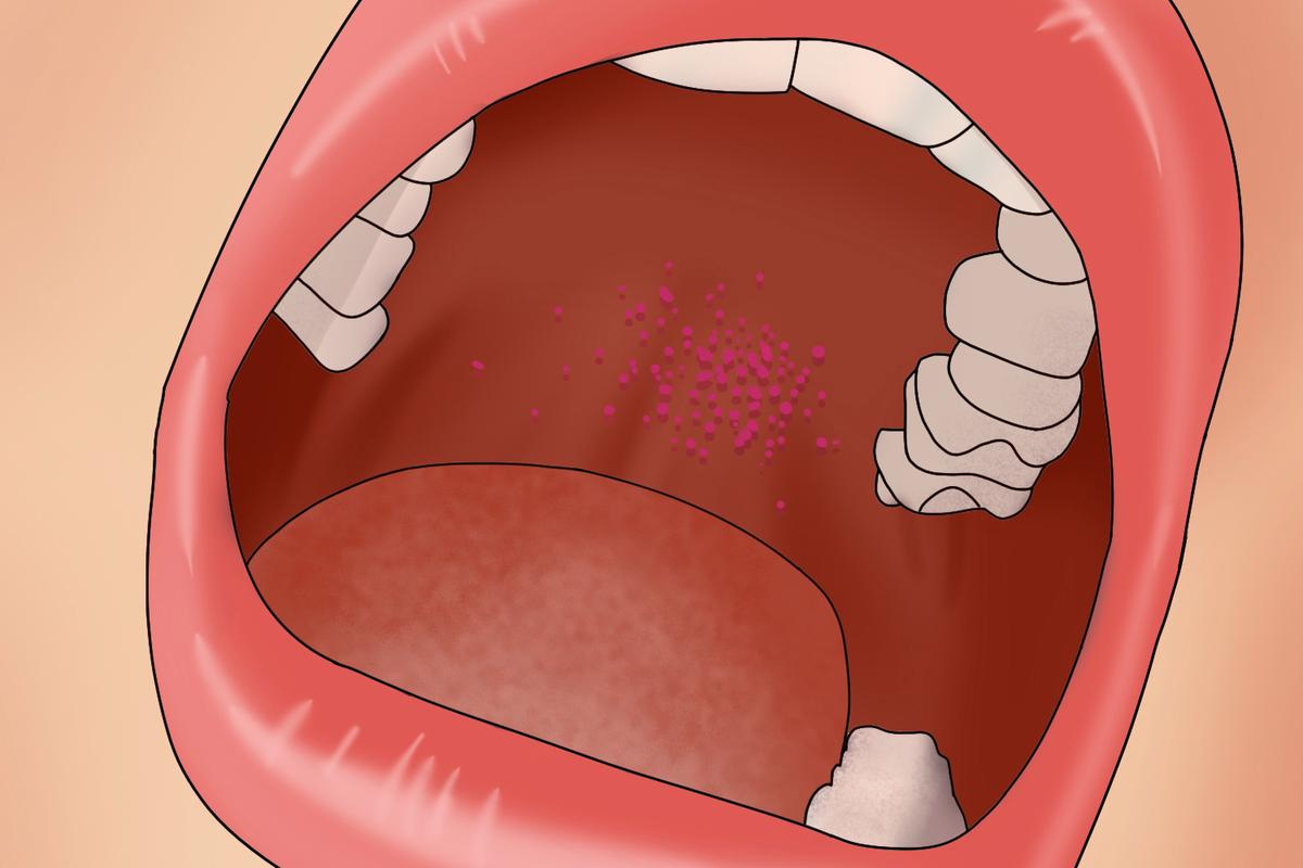 细菌性口腔炎症状图片有哪些典型表现?