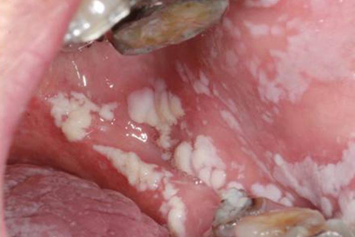 细菌性口腔炎症状图片有哪些典型表现?