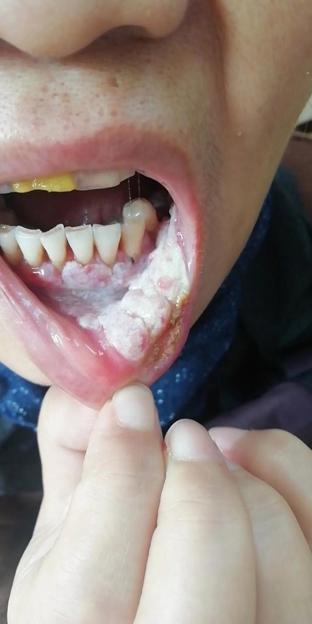 细菌性口腔炎症状图片有哪些典型表现?