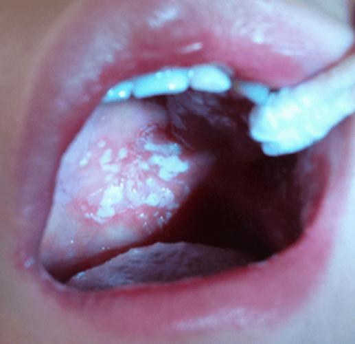 口腔有白膜是什么原因