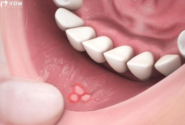 口腔壁白点颗粒状是何问题?