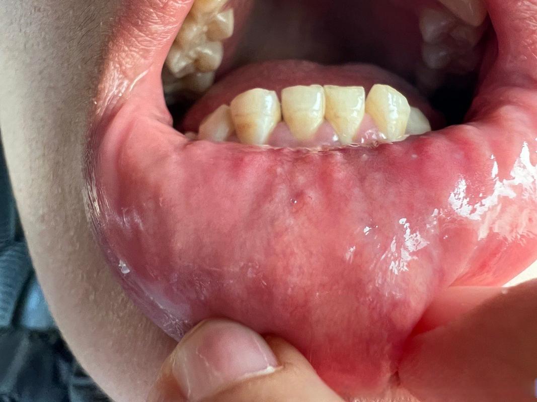 口腔壁白点颗粒状是何问题?