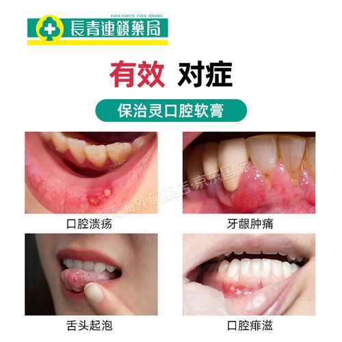 香港口腔溃疡药哪个好?