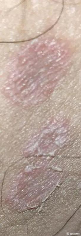 真菌皮肤病有哪些典型症状?