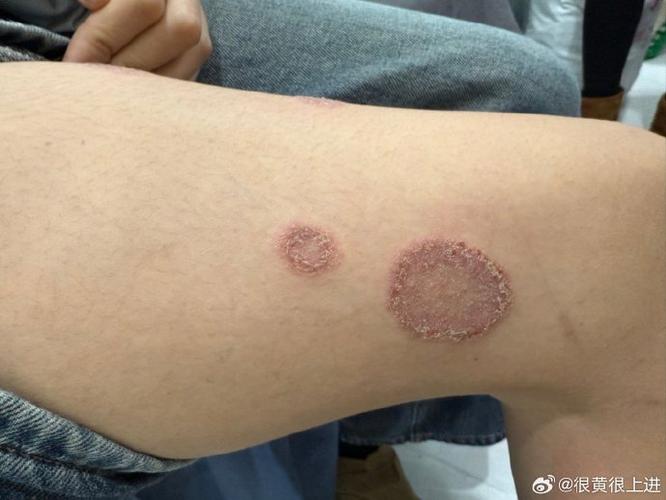 真菌皮肤病有哪些典型症状?