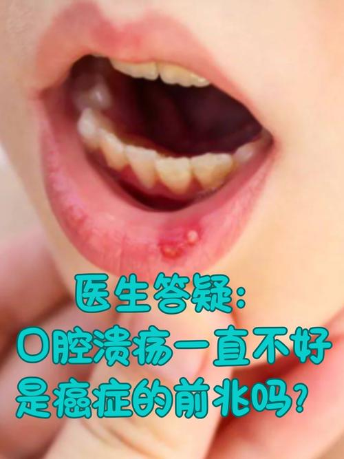 口腔溃疡是哪些疾病的信号?