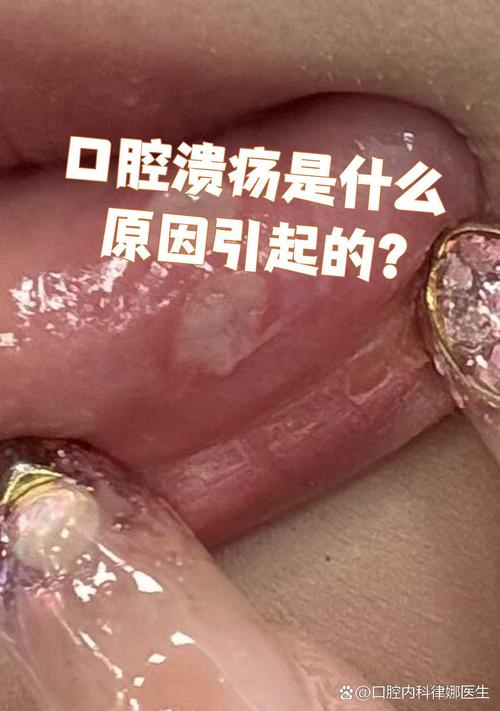 口腔溃疡是哪些疾病的信号?
