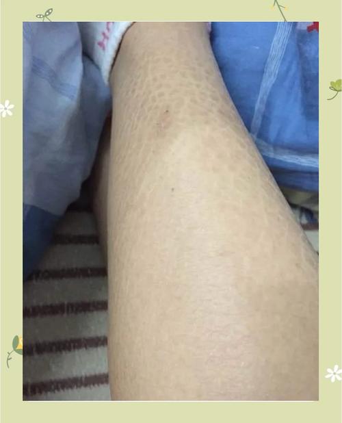 皮肤蛇皮纹是啥原因?