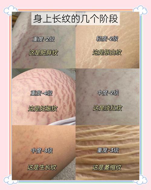 皮肤蛇皮纹是啥原因?