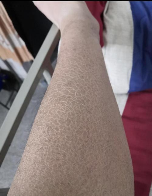 皮肤蛇皮纹是啥原因?