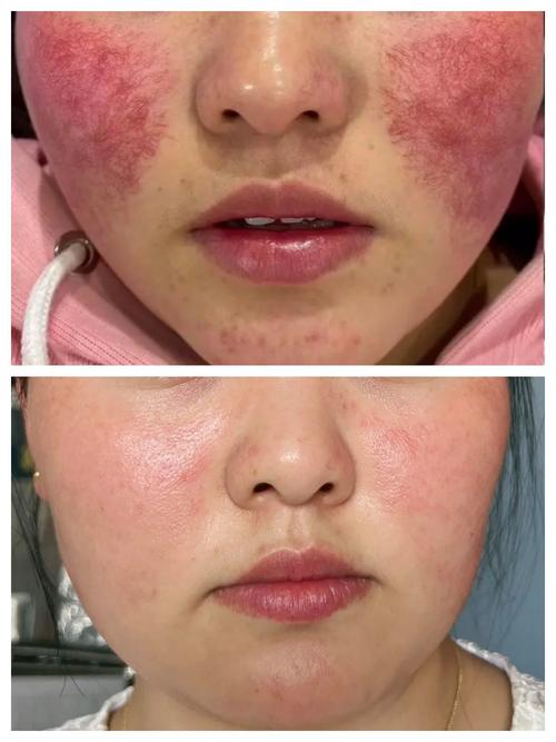 光子嫩肤会损伤皮肤吗