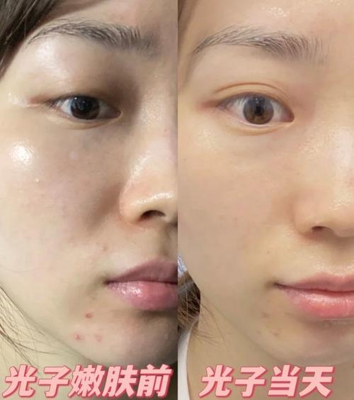 光子嫩肤会损伤皮肤吗