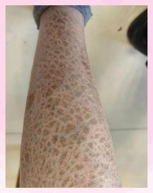 身上有鱼鳞的皮肤图片