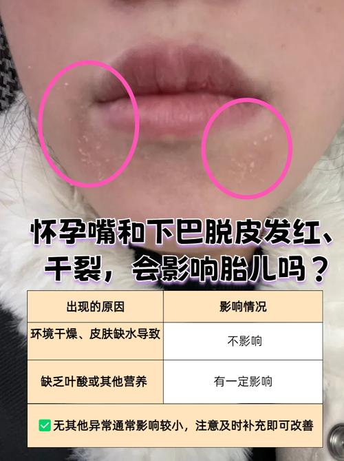 怀孕皮肤干燥能判断生男生女吗?