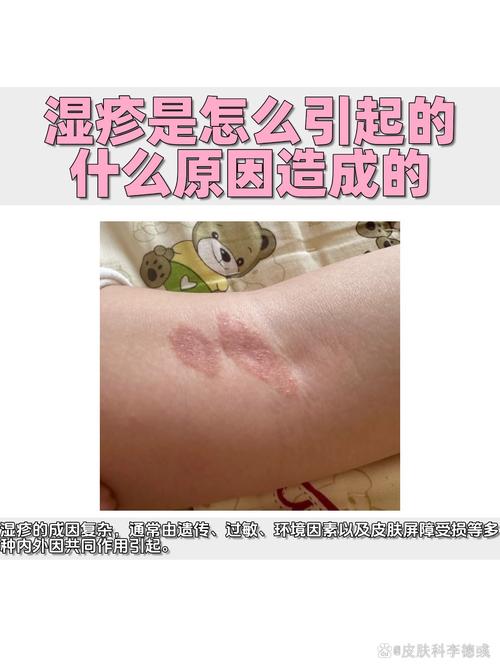 皮肤容易湿疹是缺什么