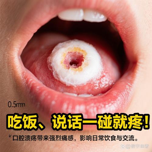 人为什么要长口腔溃疡