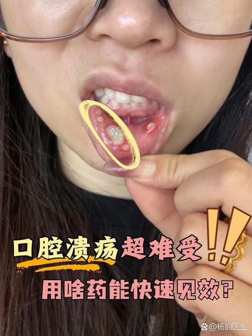 人为什么要长口腔溃疡