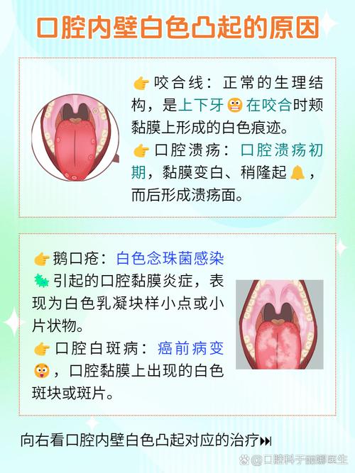 口腔白色念珠菌病如何有效治疗?