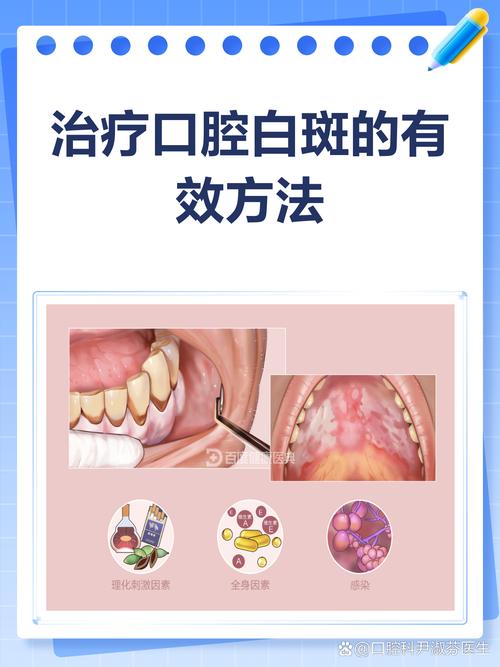 口腔白色念珠菌病如何有效治疗?
