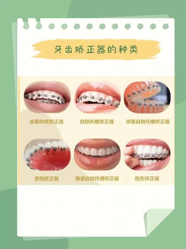 口腔科正畸具体指什么治疗?