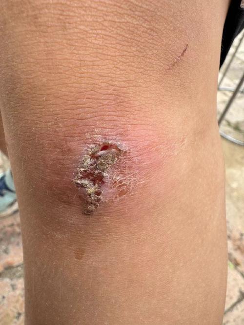 皮肤起红疙瘩结痂白皮