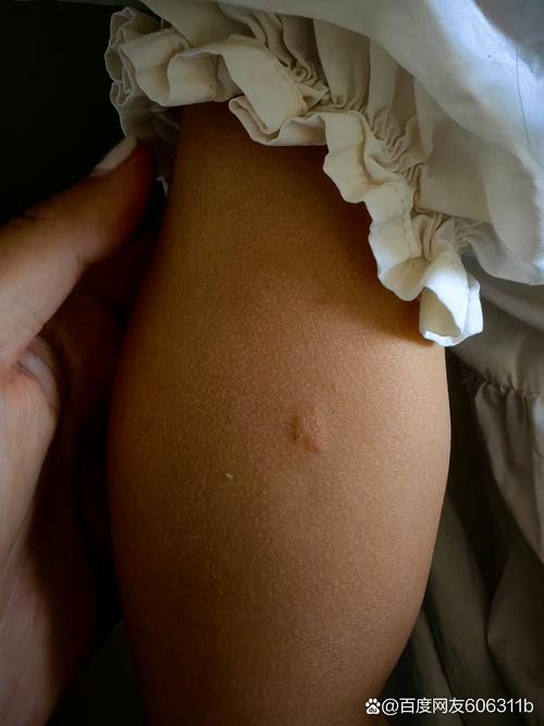 皮肤起红疙瘩结痂白皮