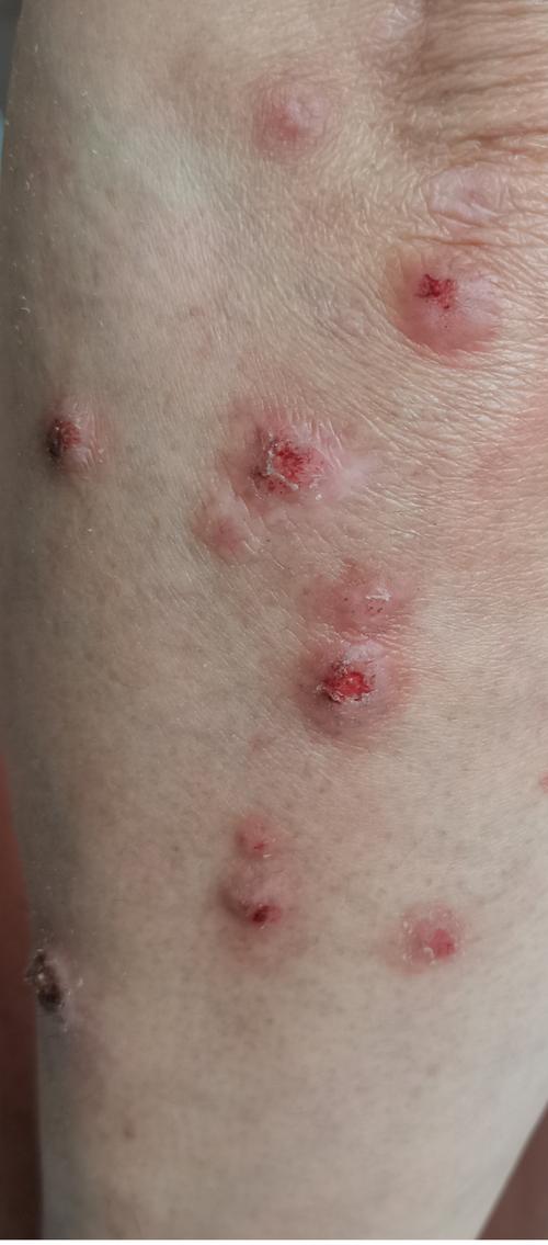 皮肤起红疙瘩结痂白皮