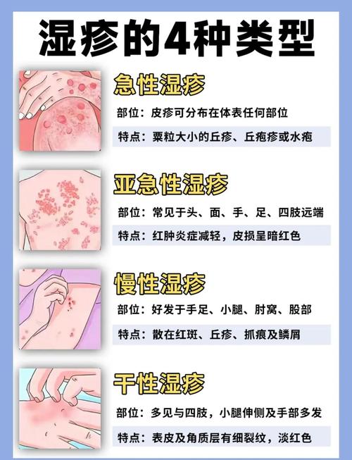 慢性湿疹皮肤如何有效治疗?