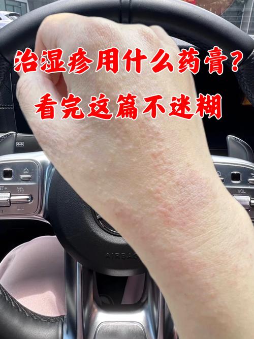 慢性湿疹皮肤如何有效治疗?