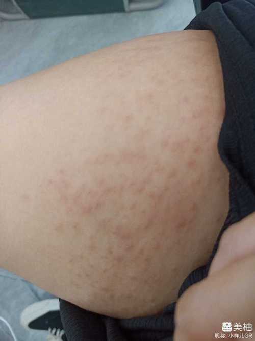 腹部皮肤瘙痒起红疙瘩