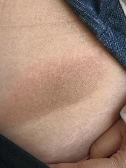 腹部皮肤瘙痒起红疙瘩